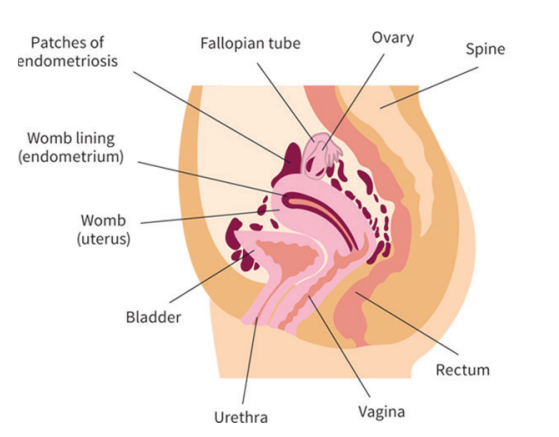 Endometriosis: A GP guide to endometriosis management :: Gold